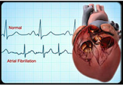 新發現一種鼻腔噴霧劑可能解決突發心臟病患者的難題